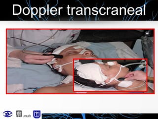 Doppler transcraneal

 