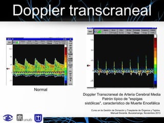 Doppler transcraneal

Normal
Doppler Transcraneal de Arteria Cerebral Media
Patrón típico de "espigas
sistólicas", característico de Muerte Encefálica
Curso en la Gestión de Donación y Trasplante de Órganos y Tejidos.
Manual Docente. Bucaramanga, Noviembre 2013

 