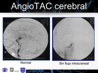 AngioTAC cerebral

Normal

Sin flujo intracraneal

 