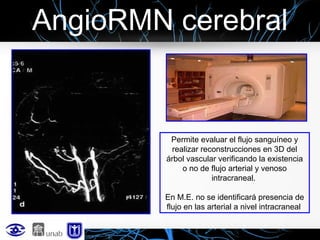 AngioRMN cerebral

Permite evaluar el flujo sanguíneo y
realizar reconstrucciones en 3D del
árbol vascular verificando la existencia
o no de flujo arterial y venoso
intracraneal.
En M.E. no se identificará presencia de
flujo en las arterial a nivel intracraneal

 