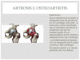 ARTROSIS U OSTEOARTRITIS
Definición:
Hace referencia al daño o
desgaste que se produce
en el cartílago articular, a
menudo como resultado
de un esfuerzo excesivo o
realizado de forma
inadecuada. Es un
desequilibrio entre síntesis y
degradación de cartílago.
La enfermedad empieza
con el desgaste lento pero
continuo del cartílago.
Ocasiona dolor y a veces
pérdida de movilidad.
 