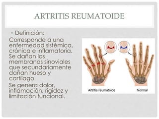 ARTRITIS REUMATOIDE
• Definición:
Corresponde a una
enfermedad sistémica,
crónica e inflamatoria.
Se dañan las
membranas sinoviales
que secundariamente
dañan hueso y
cartílago.
Se genera dolor,
inflamación, rigidez y
limitación funcional.
 