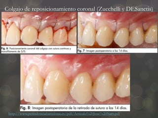 Colgajo de reposicionamiento coronal (Zucchelli y DESanctis)
http://www.periodonciabarcelona.es/pdf/Articulo%20Jose%20Nart.pdf
 