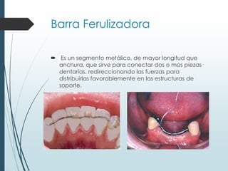 Barra Ferulizadora
 Es un segmento metálico, de mayor longitud que
anchura, que sirve para conectar dos o mas piezas
dentarias, redireccionando las fuerzas para
distribuirlas favorablemente en las estructuras de
soporte.
 