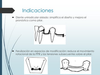 Indicaciones
 Diente uniradicular aislado: simplifica el diseño y mejora el
pronóstico como pilar.
 Ferulización en espacios de modificación: reduce el movimiento
rotacional de la PPR y las tensiones subsecuentes sobre el pilar.
 