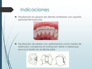 Indicaciones
 Ferulización en grupos de dientes anteriores con soporte
periodontal reducido.
 Ferulización de pilares con aditamentos como medio de
retención: compensa la inclinación distal y mesial que
provoca torsión en el diente pilar.
 