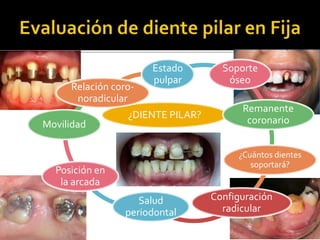 ¿DIENTE PILAR?
Estado
pulpar
Soporte
óseo
Remanente
coronario
¿Cuántos dientes
soportará?
Configuración
radicular
Salud
periodontal
Posición en
la arcada
Movilidad
Relación coro-
noradicular
 