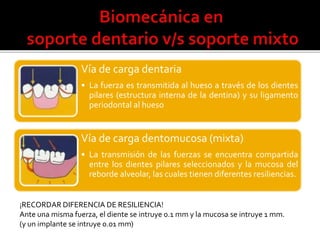 Vía de carga dentaria 
• La fuerza es transmitida al hueso a través de los dientes 
pilares (estructura interna de la dent...