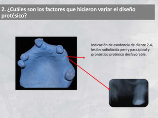 2. ¿Cuáles son los factores que hicieron variar el diseño
protésico?
Indicación de exodoncia de diente 2.4,
lesión radiolúcida peri y paraapical y
pronóstico protésico desfavorable.
 