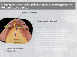 4. Explique cuáles son las palancas que se pueden generar en
PPR, en su caso clínico.
Eje de rotación (fulcrum)
Brazo de
potencia
Brazo de resistencia
Tipo de anclaje: lineal
Palanca: clase I
El anclaje en la prótesis es de tipo lineal, de
modo que al aplicar una fuerza en los dientes
de los vanos desdentado distales bilaterales,
en que la carga sobrepase la resistencia que se
le opone , generará una palanca Clase I , cuyo
eje de rotación pasa por ambos dientes pilares
adyacentes a los vanos desdentados
posteriores.
Para minimizar la rotación que tienda a
desalojar la prótesis, se planifica el uso de
retención indirecta. (Apoyos cingulares en
caninos).
 
