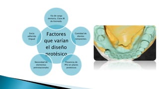 Factores
que varían
el diseño
protésico
Vía de carga
dentaria, Clase III
de Kennedy.
Cantidad de
dientes
remanentes
Presencia de
PFU en pilares
protésicos
Necesidad de
elementos
antirotacionales
Encía
adherida
lingual
 