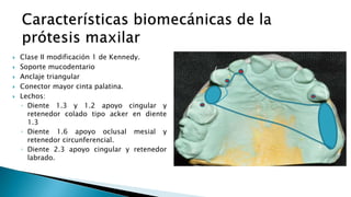  Clase II modificación 1 de Kennedy.
 Soporte mucodentario
 Anclaje triangular
 Conector mayor cinta palatina.
 Lechos:
◦ Diente 1.3 y 1.2 apoyo cingular y
retenedor colado tipo acker en diente
1.3
◦ Diente 1.6 apoyo oclusal mesial y
retenedor circunferencial.
◦ Diente 2.3 apoyo cingular y retenedor
labrado.
 