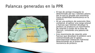  El tipo de anclaje triangular es
determinado por los 3 dientes pilares
por lo que es posible aún encontrar
cierta estabilidad biomecánica en la
prótesis.
 Al ser una prótesis de extensión libre
unilateral, al aplicar una carga oclusal
o fuerzas que intenten desalojar la
prótesis se producirá un movimiento
de rotación a través de la línea de
fulcrum, simulando una palanca de
clase I
 Este movimiento de rotación ante
fuerzas que desalojen la prótesis será
contrarrestado por el apoyo
antirrotacional (retención indirecta)
determinando así el brazo de
resistencia de prótesis
Brazo de potencia
Brazo de
Resistencia
 