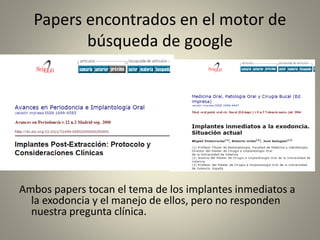 Papers encontrados en el motor de
búsqueda de google
A
Ambos papers tocan el tema de los implantes inmediatos a
la exodoncia y el manejo de ellos, pero no responden
nuestra pregunta clínica.
 