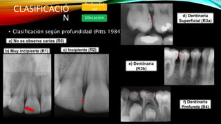Caries Code R1 Seminario n°6 caries y lesiones no cariosas | PPTX