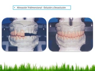 • Alineación Tridimensional - Oclusión y Desoclusión
 