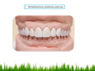 • Rehabilitaciones protésicas extensas
 