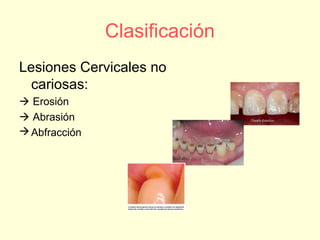 Clasificación
Lesiones Cervicales no
cariosas:
 Erosión
 Abrasión
Abfracción
 