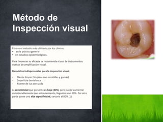 Este es el método más utilizado por los clínicos:
• en la práctica general
• en estudios epidemiológicos.
Para favorecer su eficacia se recomienda el uso de instrumentos
ópticos de amplificación visual.
Requisitos indispensables para la inspección visual:
- Diente limpio (limpieza con escobillas y gomas)
- Superficie dental seca
- Fuente de luz adecuada
La sensibilidad que presenta es baja (30%) pero puede aumentar
considerablemente con entrenamiento, llegando a un 60%. Por otra
parte posee una alta especificidad, cercana al 80%.(1)
Método de
Inspección visual
 