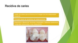 Recidiva de caries
Lesión de caries que se forma en el margen de una restauración
existente
Principal causa de recambios de restauraciones
Diagnóstico diferencial: tinciones marginales y defectos anatómicos
marginales adyacentes a una restauración
 