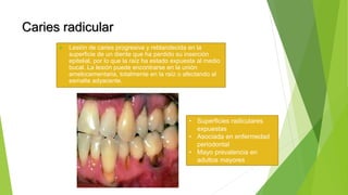 Caries radicular
 Lesión de caries progresiva y reblandecida en la
superficie de un diente que ha perdido su inserción
epitelial, por lo que la raíz ha estado expuesta al medio
bucal. La lesión puede encontrarse en la unión
amelocementaria, totalmente en la raíz o afectando al
esmalte adyacente.
• Superficies radiculares
expuestas
• Asociada en enfermedad
periodontal
• Mayo prevalencia en
adultos mayores
 
