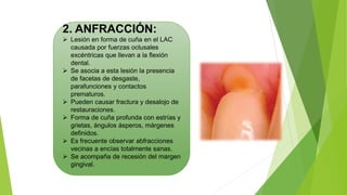 2. ANFRACCIÓN:
 Lesión en forma de cuña en el LAC
causada por fuerzas oclusales
excéntricas que llevan a la flexión
dental.
 Se asocia a esta lesión la presencia
de facetas de desgaste,
parafunciones y contactos
prematuros.
 Pueden causar fractura y desalojo de
restauraciones.
 Forma de cuña profunda con estrías y
grietas, ángulos ásperos, márgenes
definidos.
 Es frecuente observar abfracciones
vecinas a encías totalmente sanas.
 Se acompaña de recesión del margen
gingival.
 