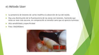e) Método láser
 La presencia de lesiones de caries modifica la absorción de luz del tejido.
 Hay una disminución de la fluorescencia de las zonas con lesiones, haciendo que
estas se vean más oscuras, en comparación al esmalte sano que se aprecia luminoso
 Alta sensibilidad y especificidad
 Foto: DIAGNOdent
 