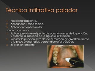 1. Posicionar paciente.
2. Aplicar anestésico tópico.
3. Aplicar antiséptico en la
zona a puncionar.
1. Aplicar presión en el punto de punción antes de la punción,
y durante la inserción de la aguja e infiltración.
2. Realizar la punción 1cm desde el margen gingival libre frente
a la pieza a anestesiar, perpendicular al paladar.
3. Infiltrar lentamente.
Técnica infiltrativa paladar
 