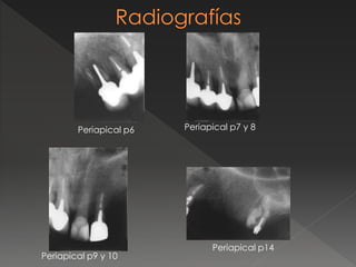 Periapical p6 Periapical p7 y 8
Periapical p9 y 10
Periapical p14
 