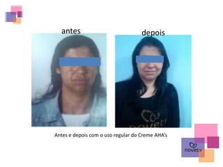 antes depois
Antes e depois com o uso regular do Creme AHA’s
 