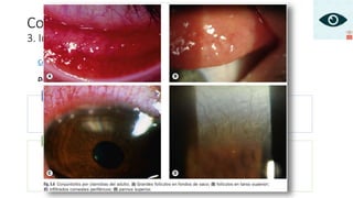 Conjuntivitis bacteriana
3. Infección por Chlamydia
Conjuntivitis por chlamydias del adulto
DIAGNÓSTICO
•Enrojecimiento uni obilateral con lagrimeo
•Secrecion de inicio subagudo
•Se puede cronificarn
•¿? Sobre actividad sexual
Síntomas
•Secreción acuosa o mucopurulenta
•Adenopatía preauricular dolorosa
•Foliculos grandes (fondo de saco inferior, conjuntiva tarsal sup)
•Queratitis punteada sup (f)
•Infiltrados subepiteliales en la córnea perilímbica
•Cicatrización conjuntival leve, pannus corneal sup
Signos
 
