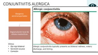 CONJUNTIVITIS ALERGICA
Clínica:
• Ojo rojo bilateral
• Secreción acuosa
• Comezón
Alergenos
aerotransportados
Contacto con la
conjuntiva
↑Ig E
Degranulación local de
células mastociticas
Mediadores
Histamina, eosinófilos,
factores quimiotáxicos,
factor activador de
plaquetas, etc
 
