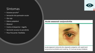 Síntomas
• Excesivo prurito*
• Sensación de quemazón ocular
• Ojo rojo
• Edema palpebral
• Bilateral
• Costra al despertar ≈ lagaña
• Secreción acuosa no purulenta
• Poco frecuente: fotofobia
 