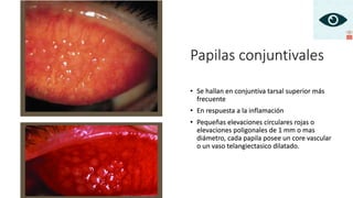 Papilas conjuntivales
• Se hallan en conjuntiva tarsal superior más
frecuente
• En respuesta a la inflamación
• Pequeñas elevaciones circulares rojas o
elevaciones poligonales de 1 mm o mas
diámetro, cada papila posee un core vascular
o un vaso telangiectasico dilatado.
 