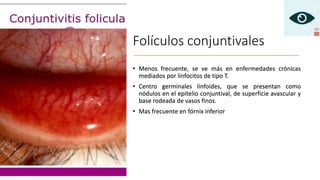 Folículos conjuntivales
• Menos frecuente, se ve más en enfermedades crónicas
mediados por linfocitos de tipo T.
• Centro germinales linfoides, que se presentan como
nódulos en el epitelio conjuntival, de superficie avascular y
base rodeada de vasos finos.
• Mas frecuente en fórnix inferior
 