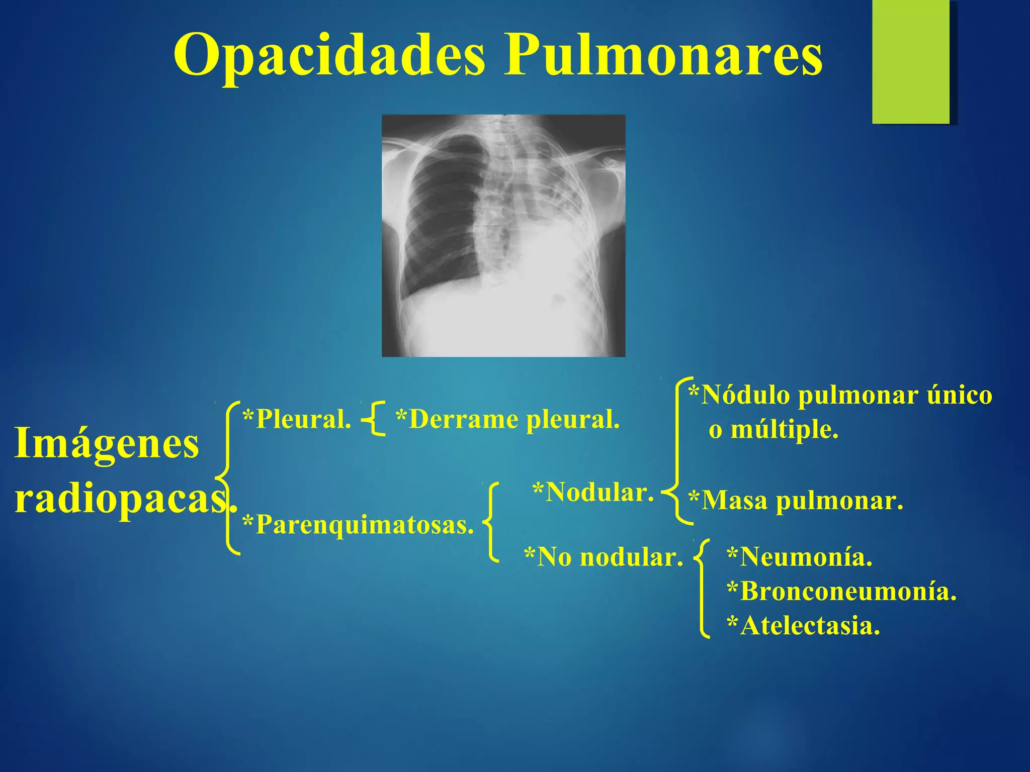 Opacidades pulmonares en Imagenología
