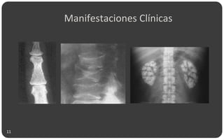 Manifestaciones Clínicas
11
 