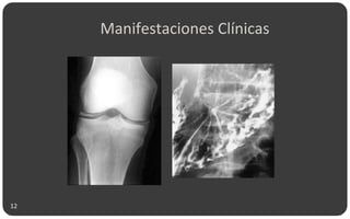 Manifestaciones Clínicas
12
 
