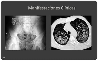 Manifestaciones Clínicas
13
 