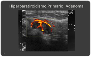 17
Hiperparatiroidismo Primario: Adenoma
 