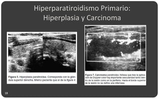 Hiperparatiroidismo Primario:
Hiperplasia y Carcinoma
18
 