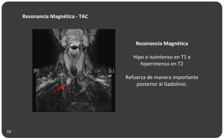 Resonancia Magnética - TAC
Resonancia Magnética
Hipo o isointenso en T1 e
hiperintenso en T2
Refuerza de manera importante
posterior al Gadolinio.
19
 