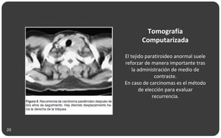 Tomografía
Computarizada
El tejido paratiroideo anormal suele
reforzar de manera importante tras
la administración de medio de
contraste.
En caso de carcinomas es el método
de elección para evaluar
recurrencia.
20
 