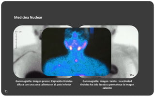 Gammagrafía: Imagen precoz: Captación tiroidea
difusa con una zona caliente en el polo inferior
Gammagrafía: Imagen tardía: la actividad
tiroidea ha sido lavada y permanece la imagen
caliente
Medicina Nuclear
21
 