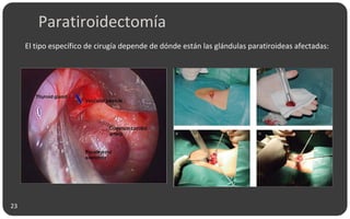 Paratiroidectomía
El tipo específico de cirugía depende de dónde están las glándulas paratiroideas afectadas:
23
 