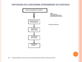 PATOGENIA DO CARCINOMA EPIDERMÓIDE DO ESÔFAGO
 