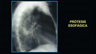 Patologías de esófago en Imagenología | PPTX
