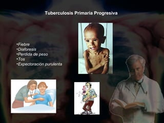 Tuberculosis Primaria Progresiva Fiebre Diaforesis Perdida de peso Tos Expectoración purulenta 