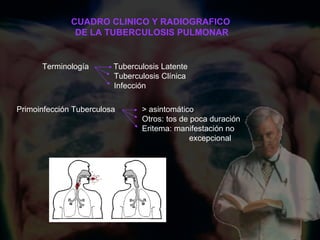 CUADRO CLINICO Y RADIOGRAFICO  DE LA TUBERCULOSIS PULMONAR Terminología  Tuberculosis Latente Tuberculosis Clínica Infección Primoinfección Tuberculosa  > asintomático Otros: tos de poca duración Eritema: manifestación no excepcional   