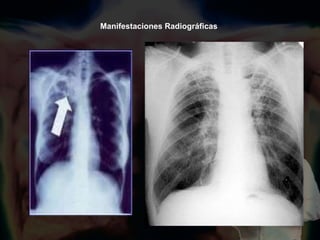 Manifestaciones Radiográficas 